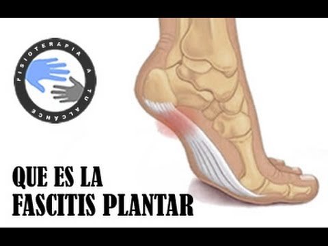 Que es la fascitis plantar