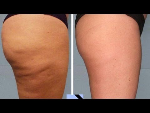 Remedios para la celulitis