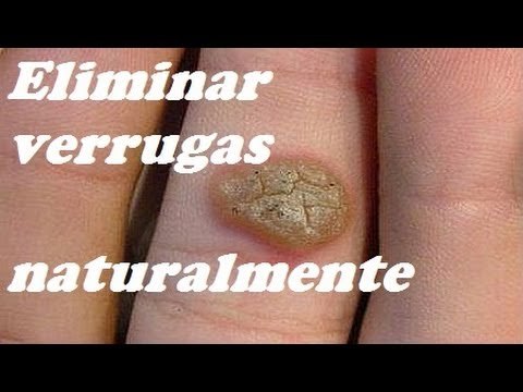 Remedios para eliminar verrugas