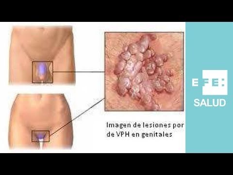 El virus del papiloma se contagia "muy fácil"
