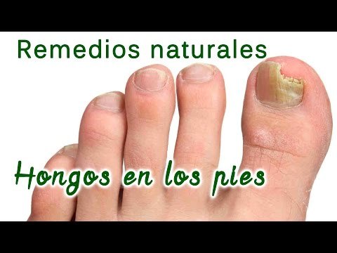 Cómo tratar los molestos hongos en la piel