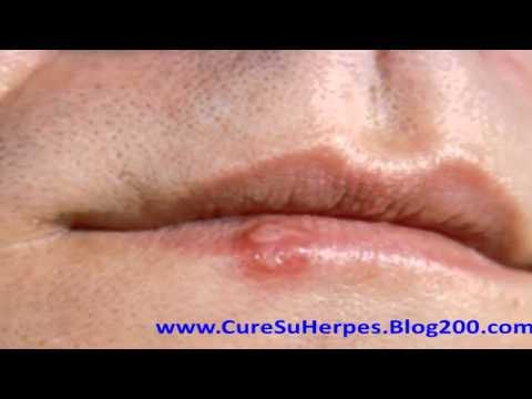 Remedios caseros para el herpes labial
