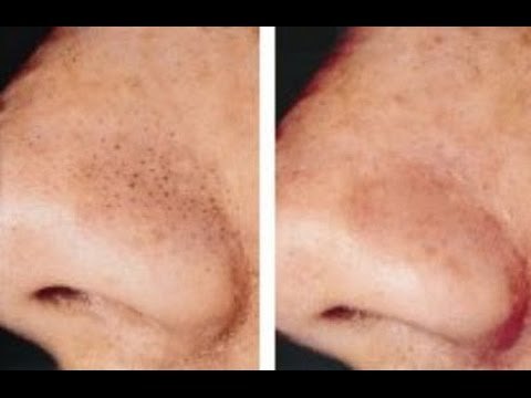 Eliminar puntos negros de la nariz 