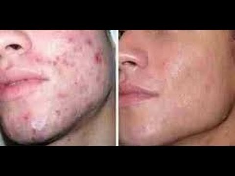 Remedios naturales para eliminar el acné