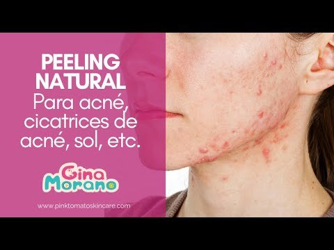 Quitar manchas y acné con peeling natural