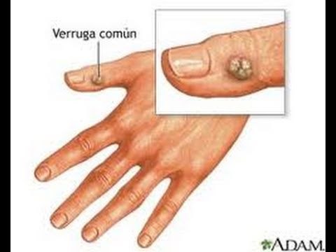 Eliminar verrugas de forma natural