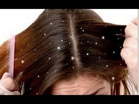 Eliminar la caspa en forma natural