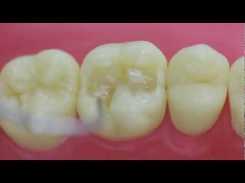 Restauración dental con Resina