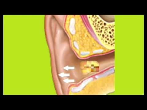 Limpiar oidos adecuadamente