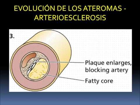 Documental - La Hipertensión arterial