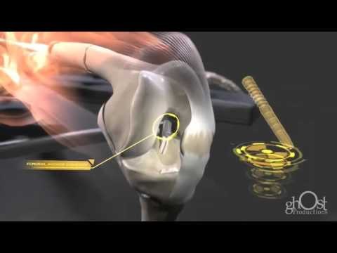 Cómo se repara una fractura de huesos