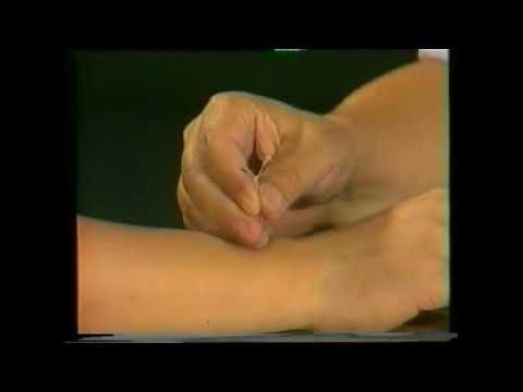 Acupuntura técnicas básicas II