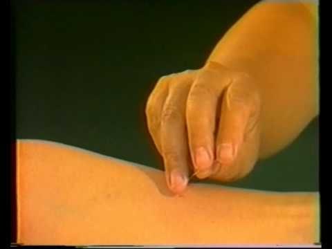 Acupuntura técnicas adicionales II